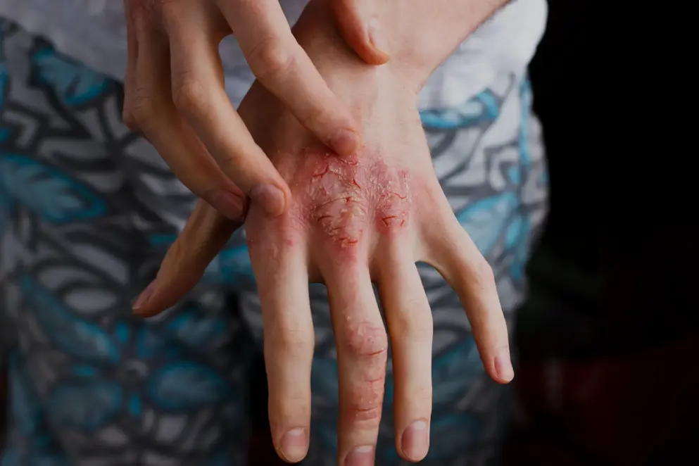 Atopic dermatitis hand