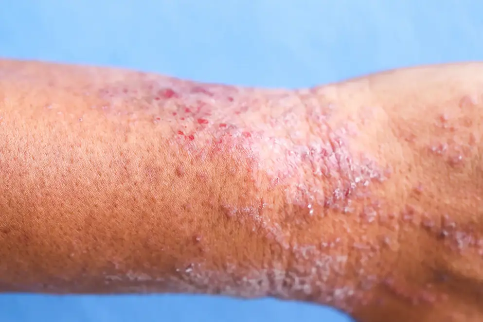 Atopic Dermatitis on arm