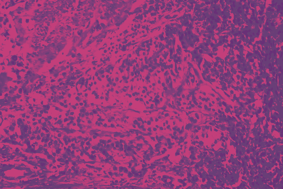 Bladder cancer cells on a pink background