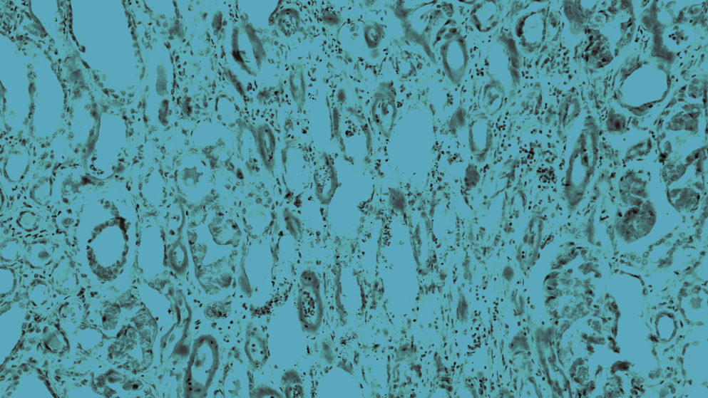 Blue micrograph image of kidney tissue showing amyloid deposition characteristic of AL amyloidosis