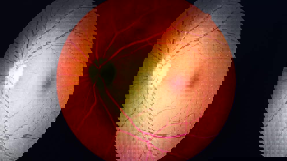 diabetes retinopathy