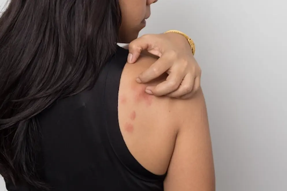 Woman with dark hair showing her back covered in urticaria/wheals, scratching over her shoulder