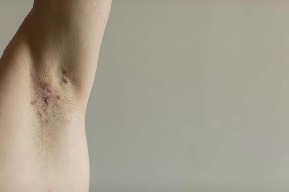 Armpit affected by HS (Hidradenitis suppurativa)