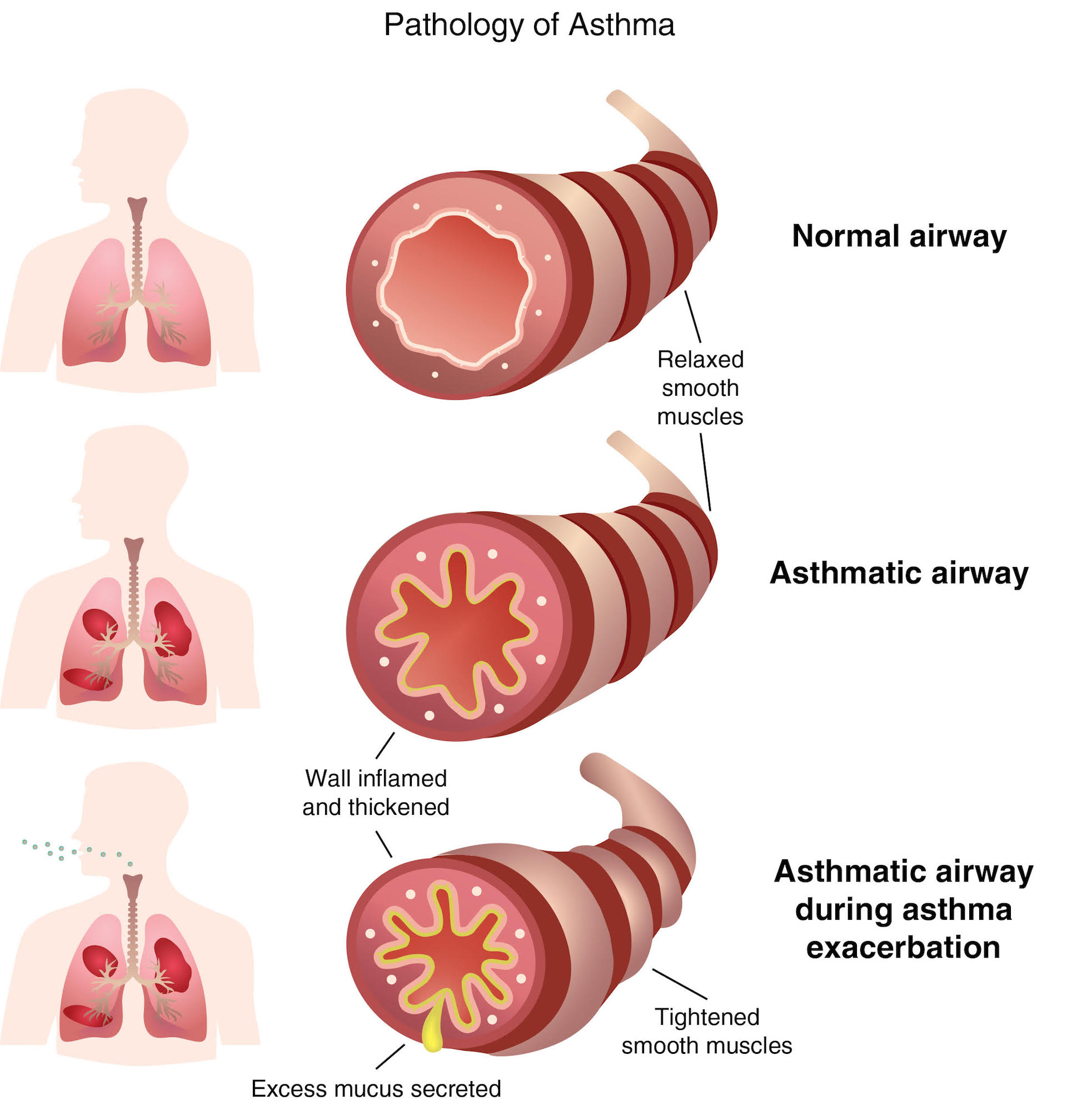 How effective are bronchodilators for asthma