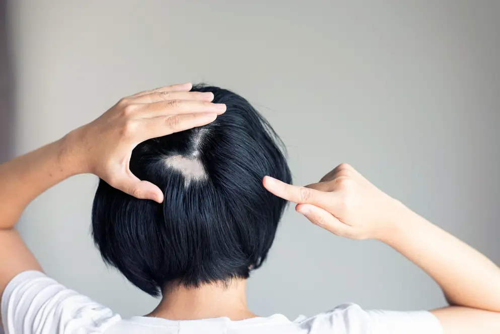 Woman pointing to her head with alopecia.