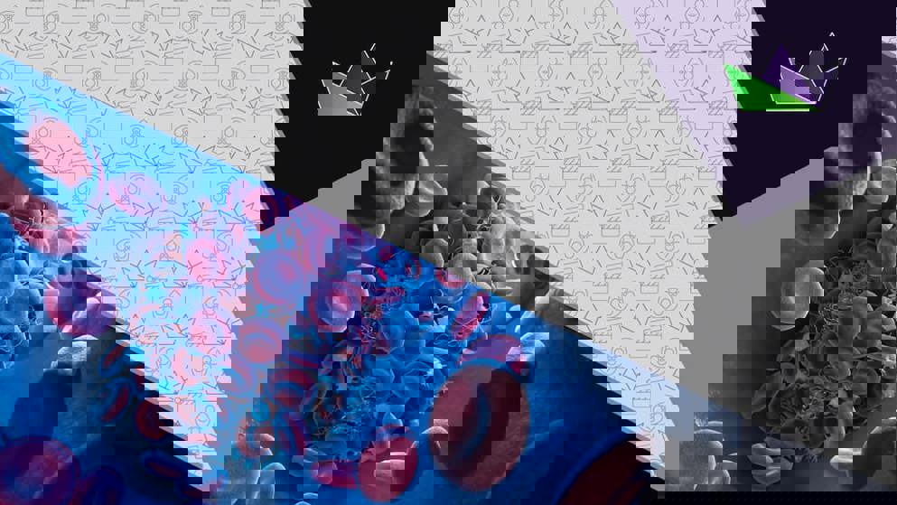 Is there a scenario where you would ever use anticoagulation and antiplatelet drugs together in patients with AF?