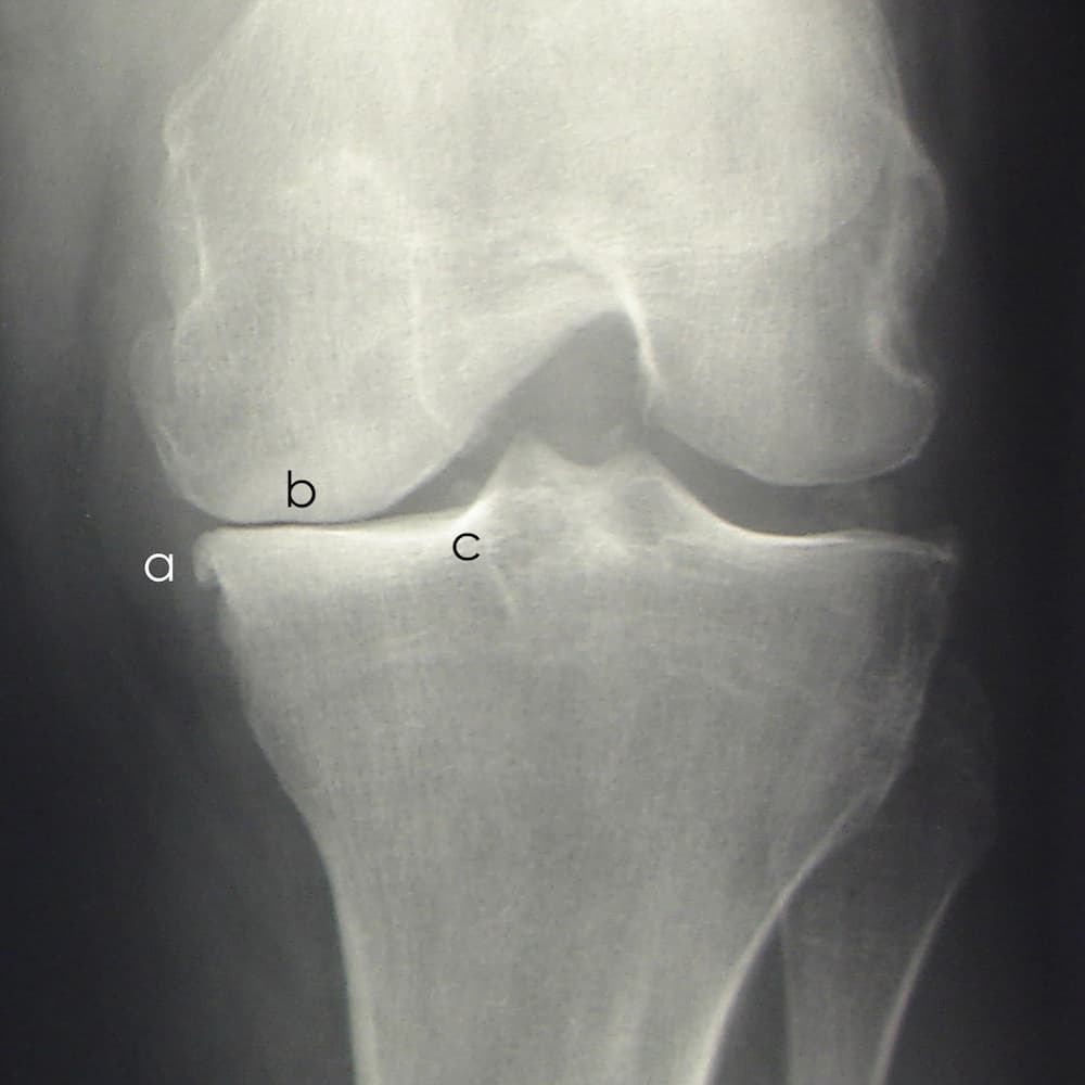 Radiographs showed osteophytes, joint space narrowing, and subchondral bone sclerosis