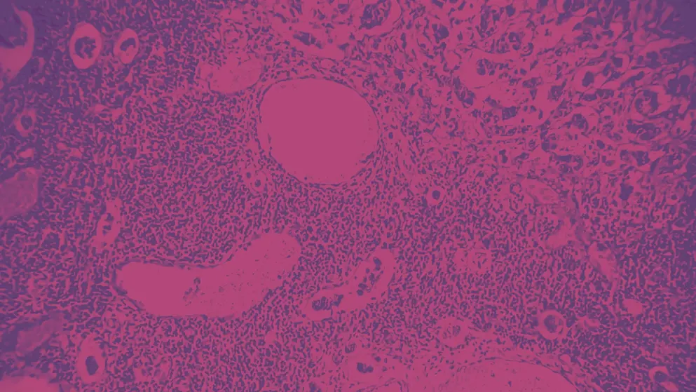 breast core biopsy showing an invasive ductal carcinoma grade-II, most common form of breast cancer, cell image, pink overlay