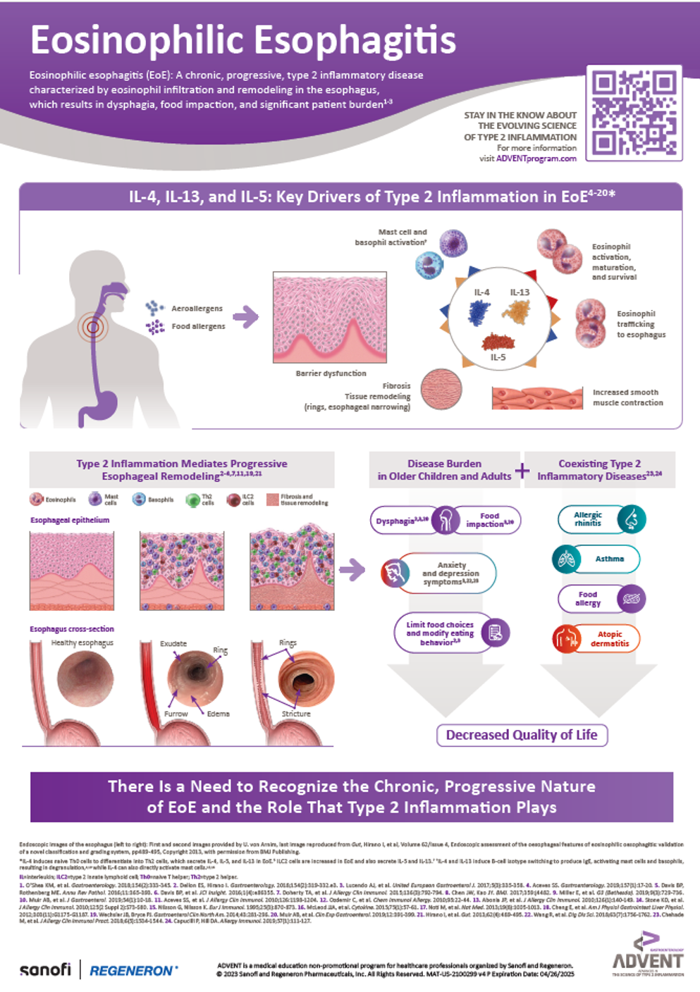 Eosinophilic Esophagitis: A Chronic, Progressive, Type 2 Inflammatory Disease Infographic