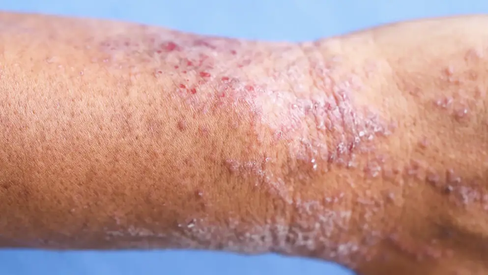 Atopic dermatitis on arm