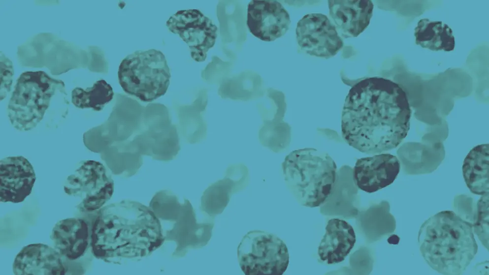 Acute myeloid leukemia, cellular image, blue overlay