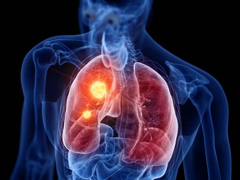 Non-small cell lung cancer (NSCLC)