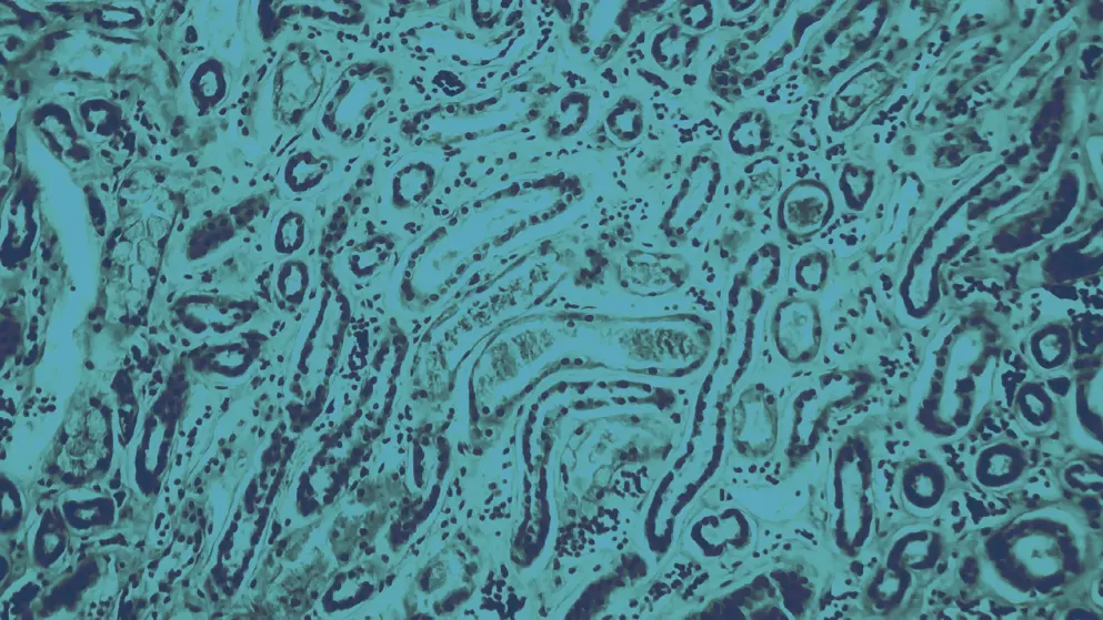 Diffuse proliferative glomerulonephritis, cellular image, blue overlay