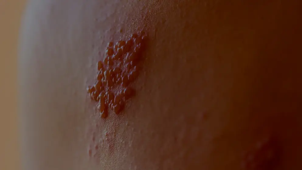 Comprehensive Guide to Herpes Zoster (Shingles): Symptoms, Treatment ...