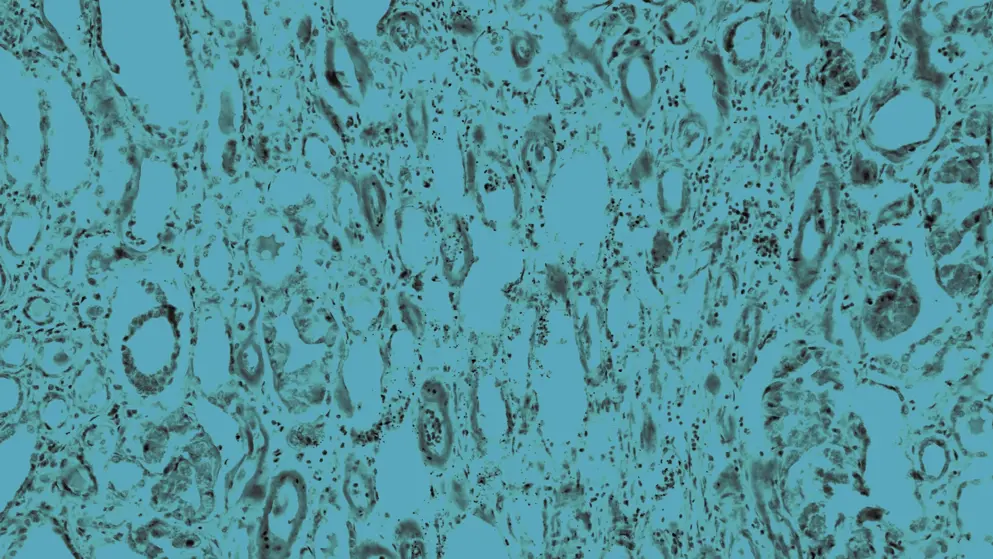 Human Kidney Amyloidosis, cellular image, blue overlay