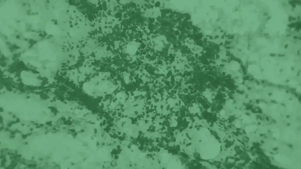 Bronchoalveolar lavage, cell image, green overlay