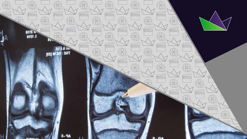 Xray stock photo of osteoarthritis knee