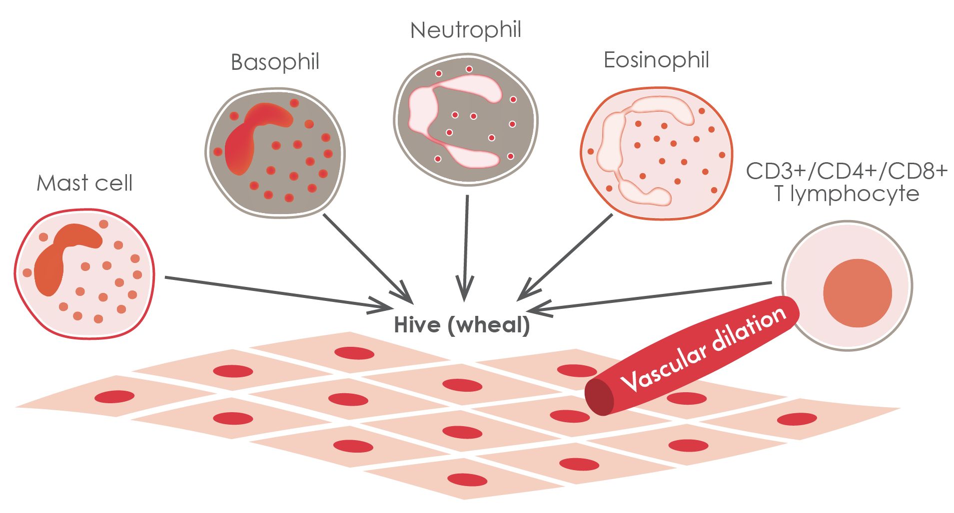 The recruitment of mast cells, basophils, neutrophils, eosinophils and T-lymphocytes in CSU skin lesions