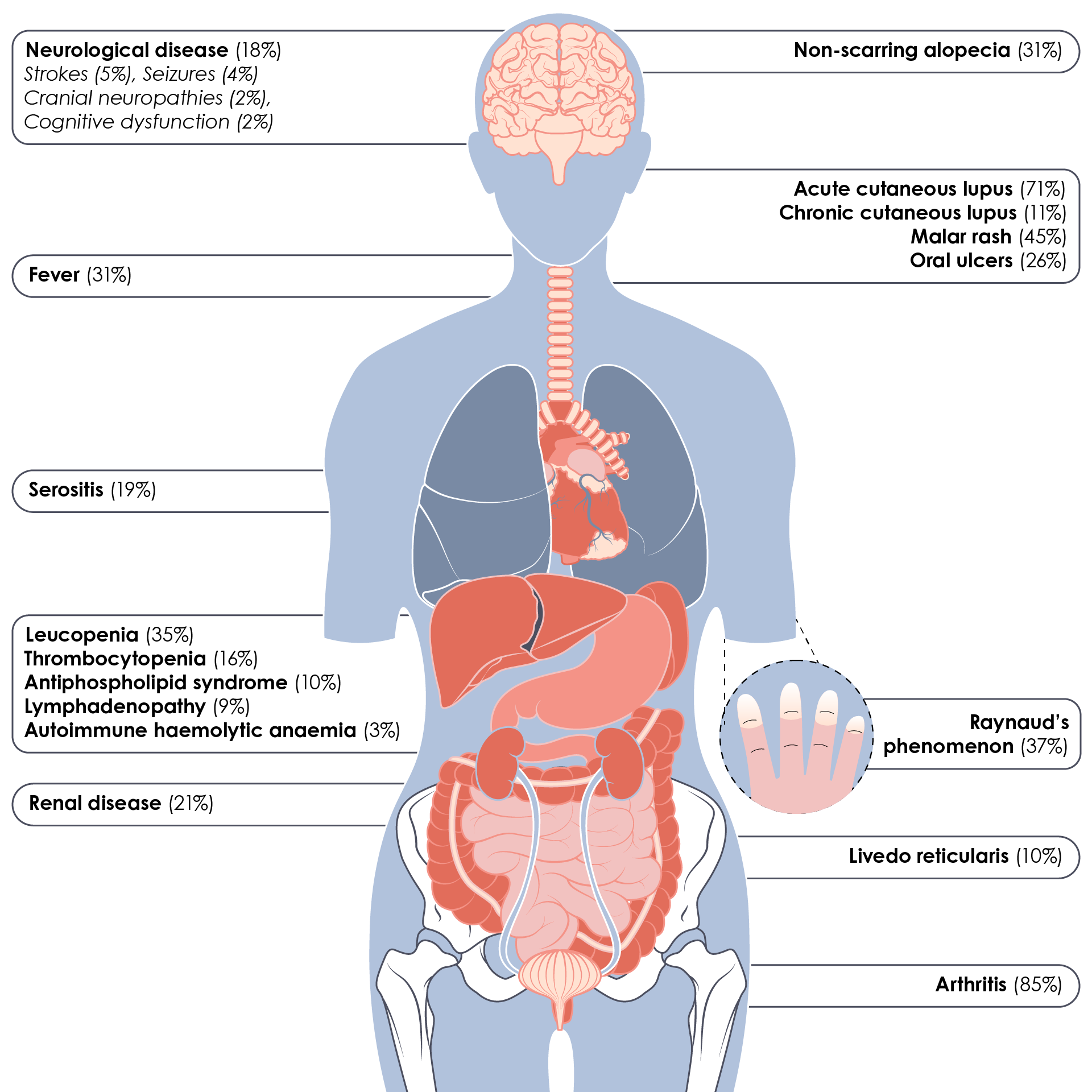 Summary of the signs and symptoms of SLE showing cumulative frequencies for each