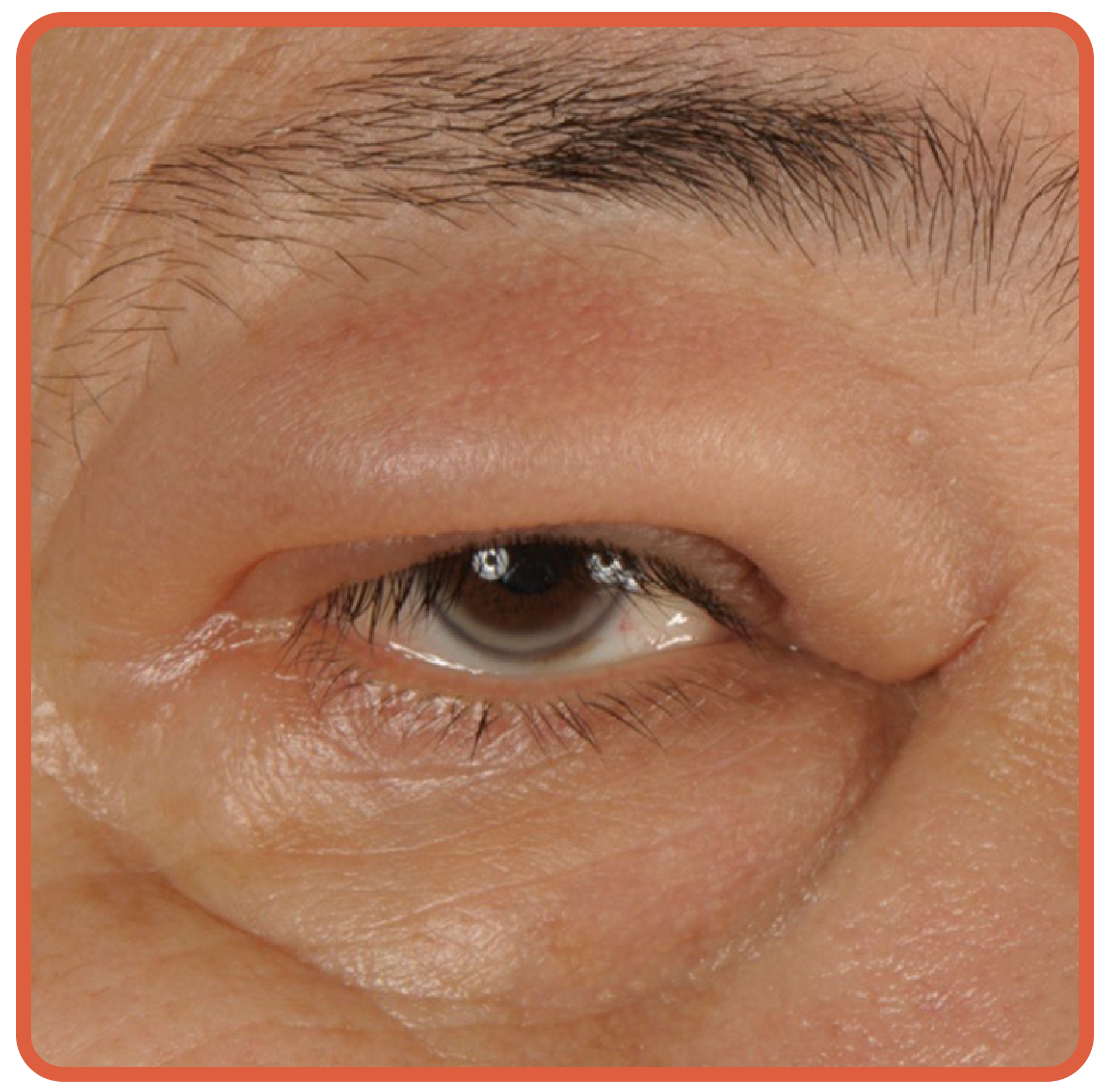 Image showing angioedema of the upper eyelid, with noticeable deep swelling and no change in skin color.