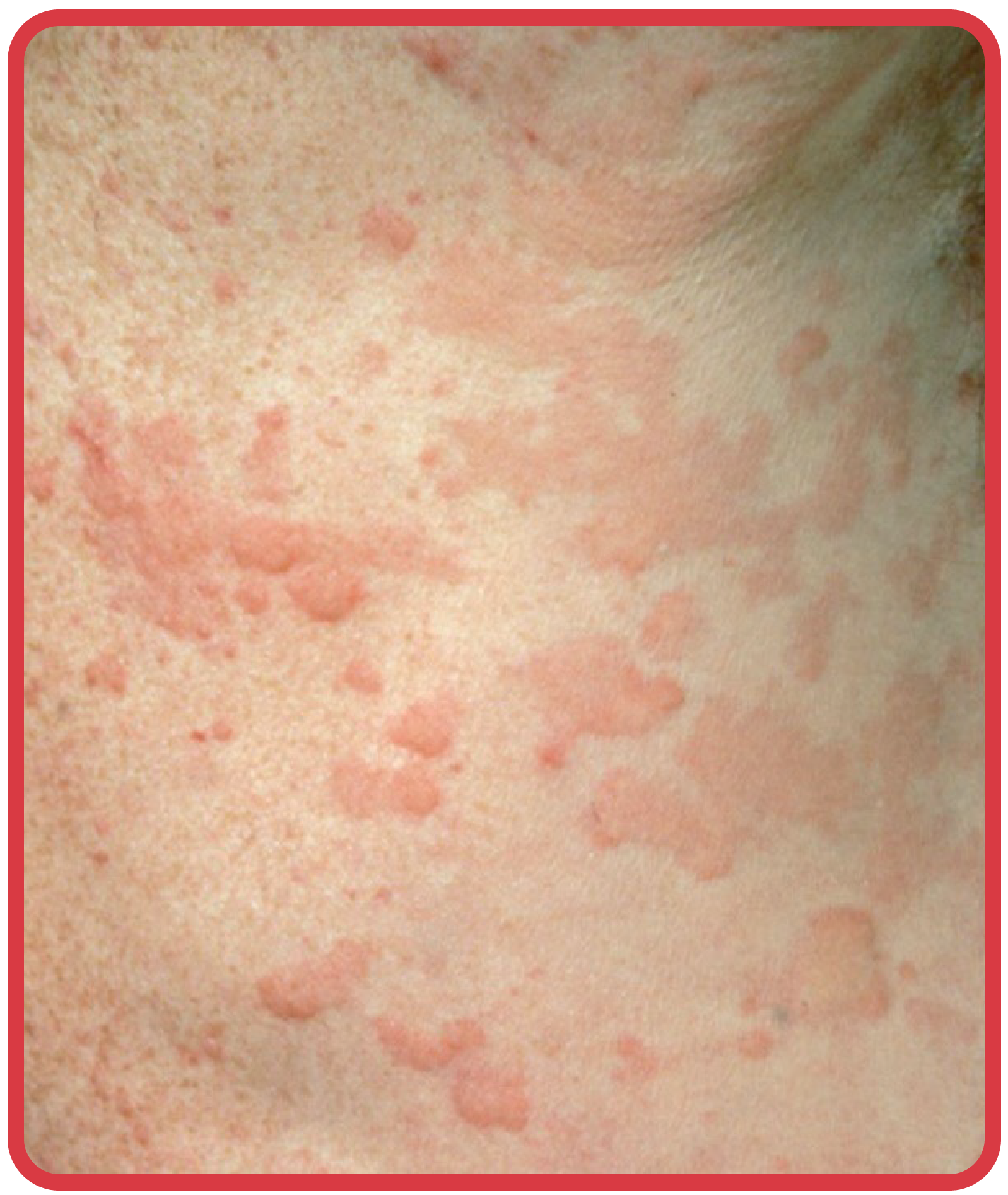 Image showing multiple pale-centered, red-edged hives on the upper chest area. The swellings vary in size and are merging in places.