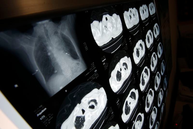 Certain patients with advanced lung cancer may be saved by transplant-