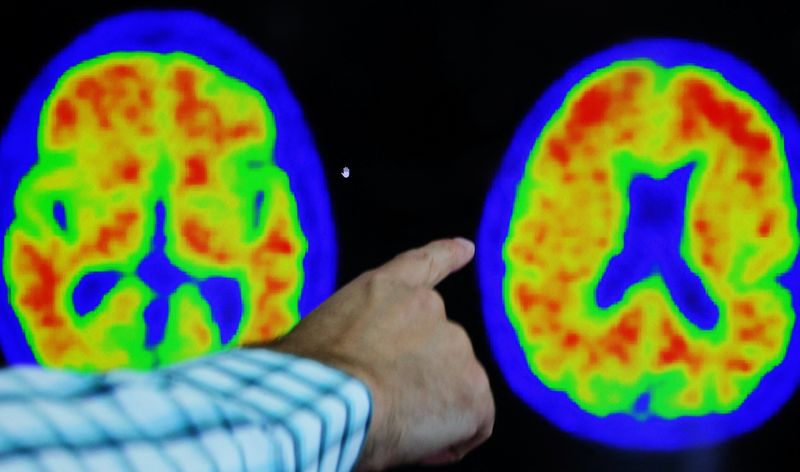 Health Rounds: Genetic discovery yields clues toward reversal of Alzheimer's brain damage-